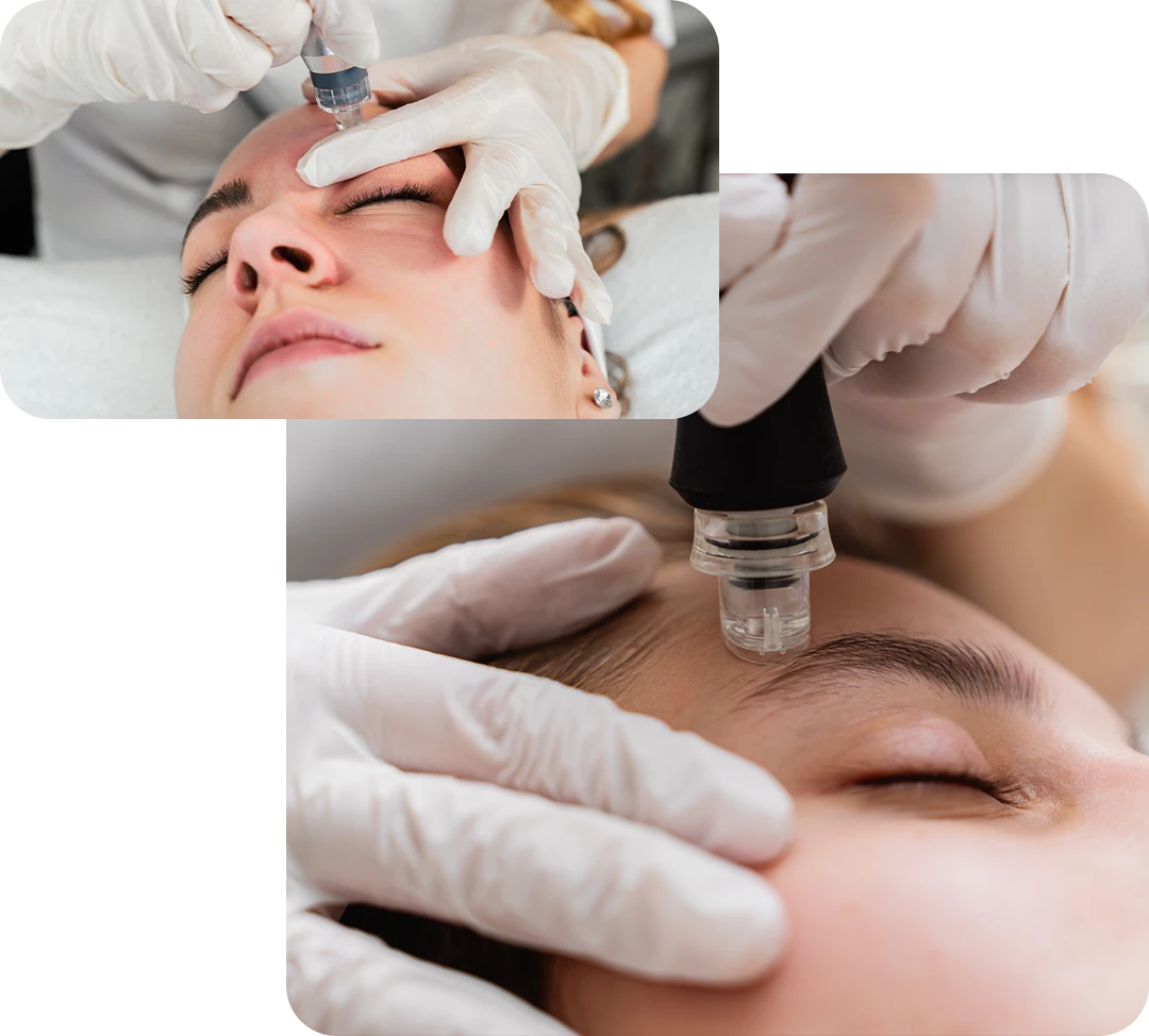Microdermabrasion Columbus Ohio